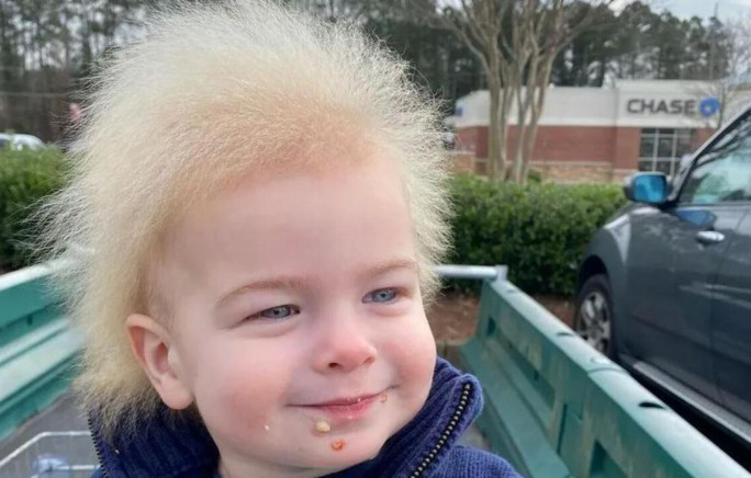 Locklan Samples foi diagnosticado com 'síndrome do cabelo impenteável' aos 10 meses