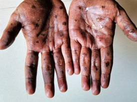 Governo refor&ccedil;a vigil&acirc;ncia contra o v&iacute;rus Mpox - DR