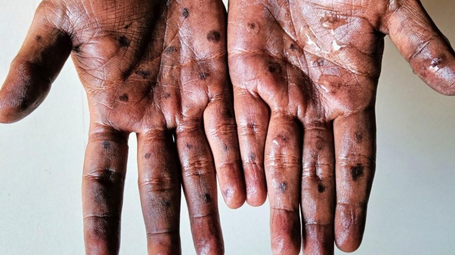 angola-refor-a-sistema-de-vigil-ncia-ao-v-rus-mpox