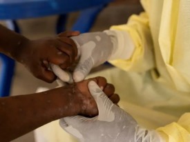 Confirmados casos de Mpox em Angola - Arquivo - DR