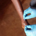Casos de var&iacute;ola dos macacos (Mpox) confirmados em Cabinda - Arquivo