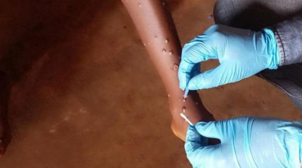 casos de mpox aumentam no Malawi