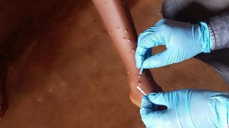 casos de mpox aumentam no Malawi