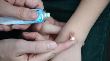 Cientistas criam medicamento capaz de reduzir cicatrizes em mais de 50 porcento  - DR