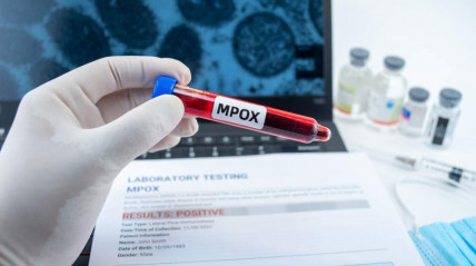 Autoridades da Namíbia declaram surto de mpox em Swakopmund - DR